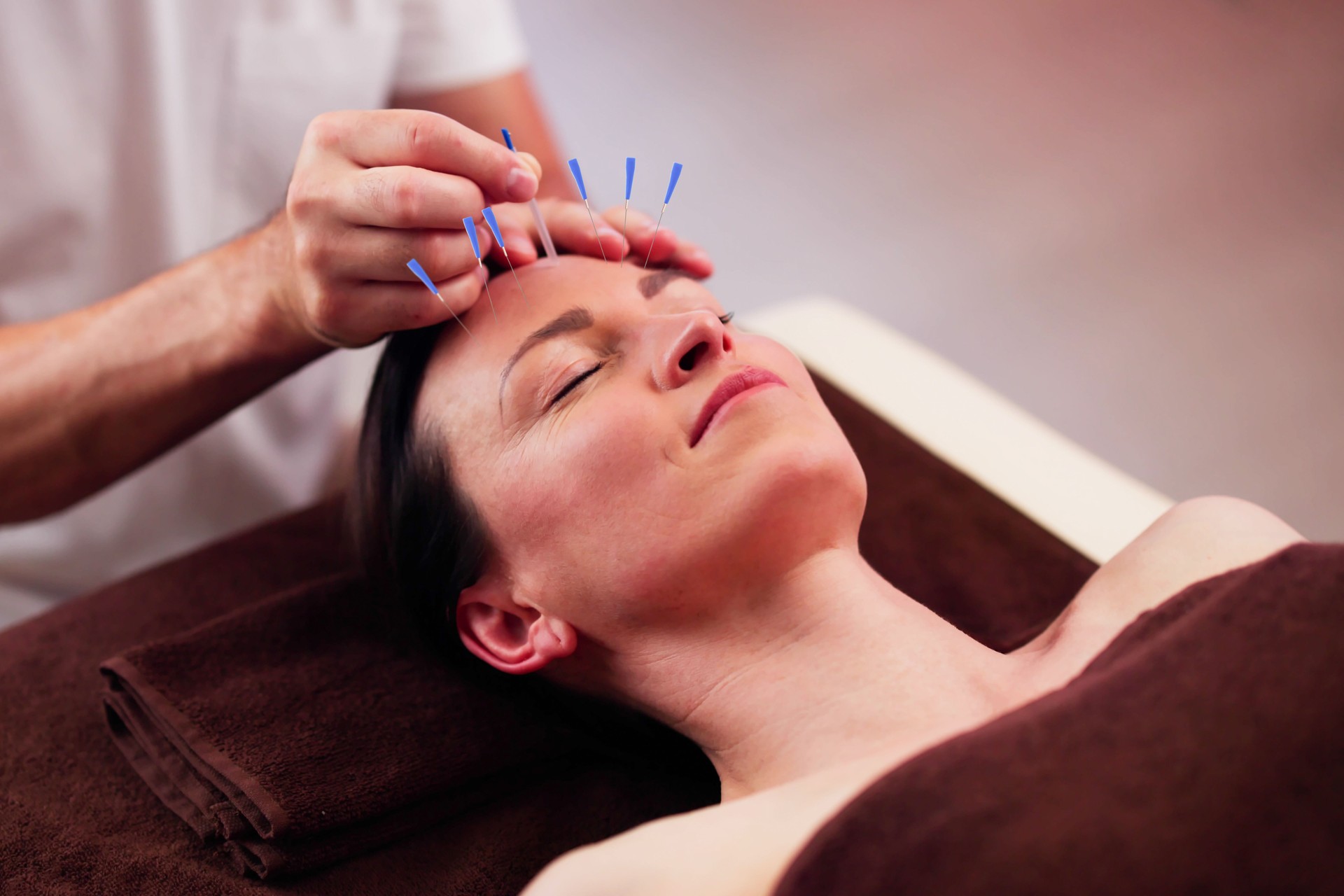 Relaxed Young Woman Receiving Acupuncture Treatment